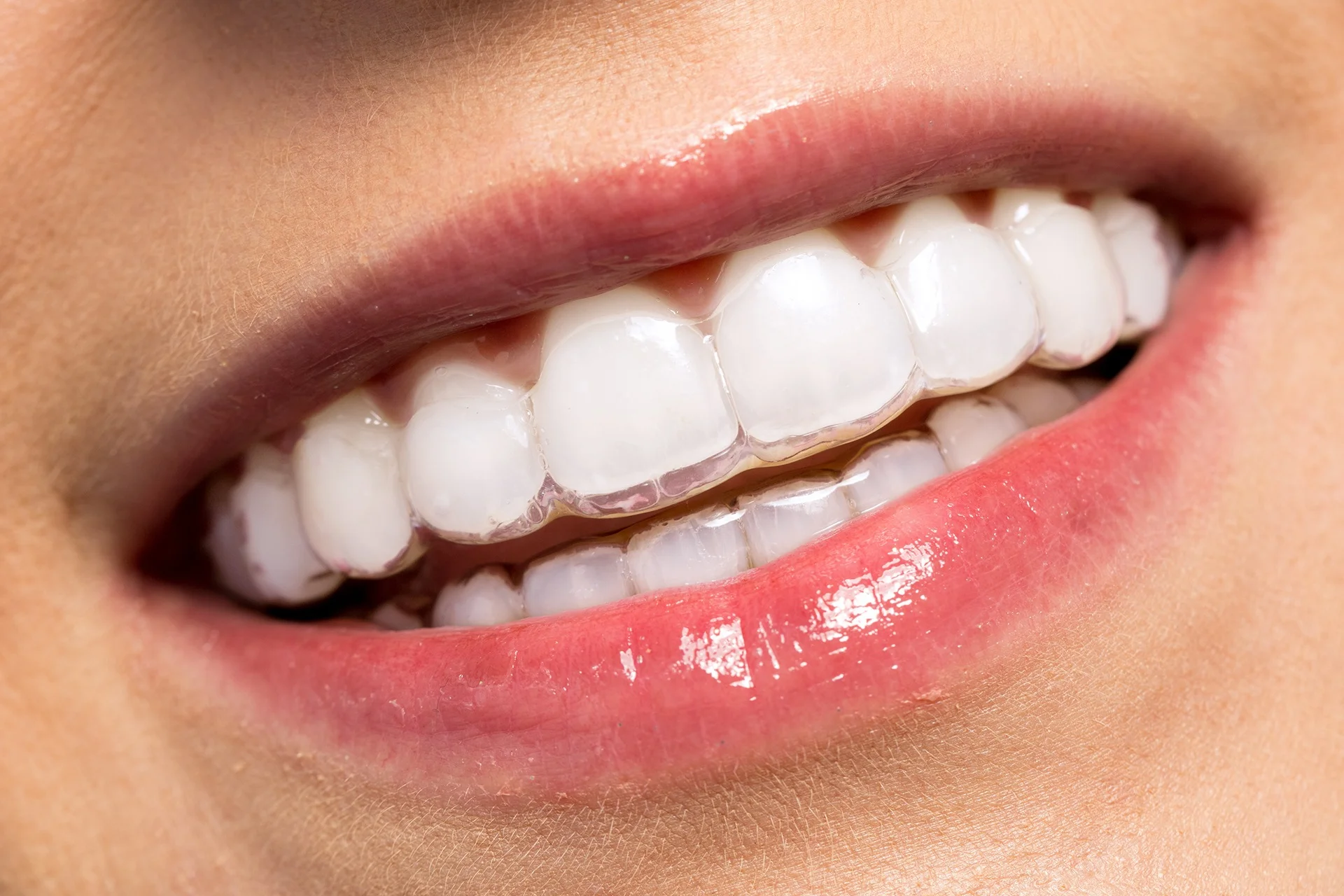 After Orthodontics