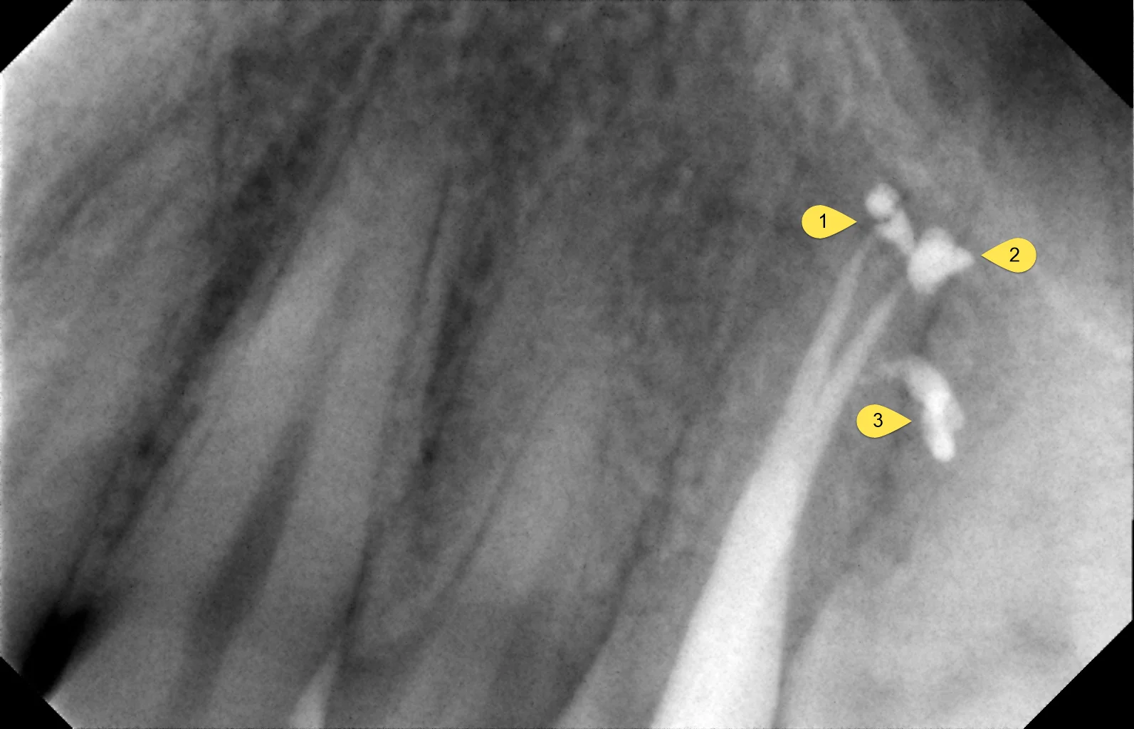 Pre Molar With 3 Roots