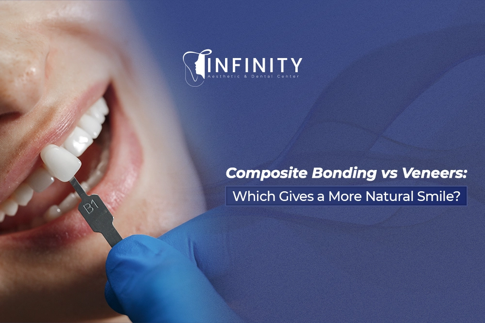 bonding vs veneers