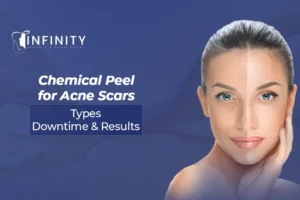 chemical peel for acne scars