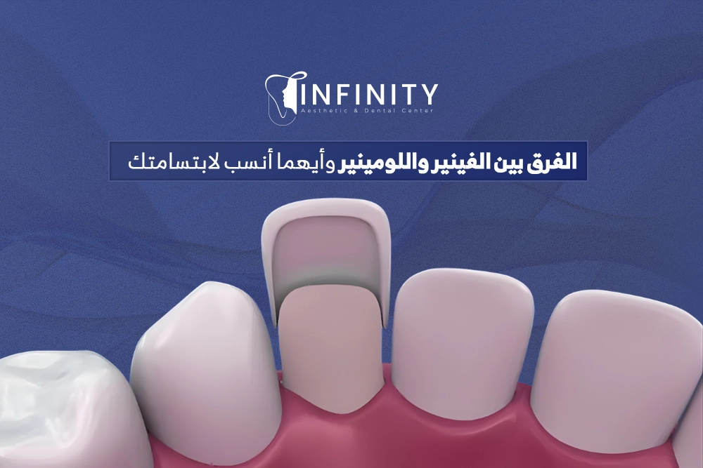 الفرق بين الفينير واللومينير