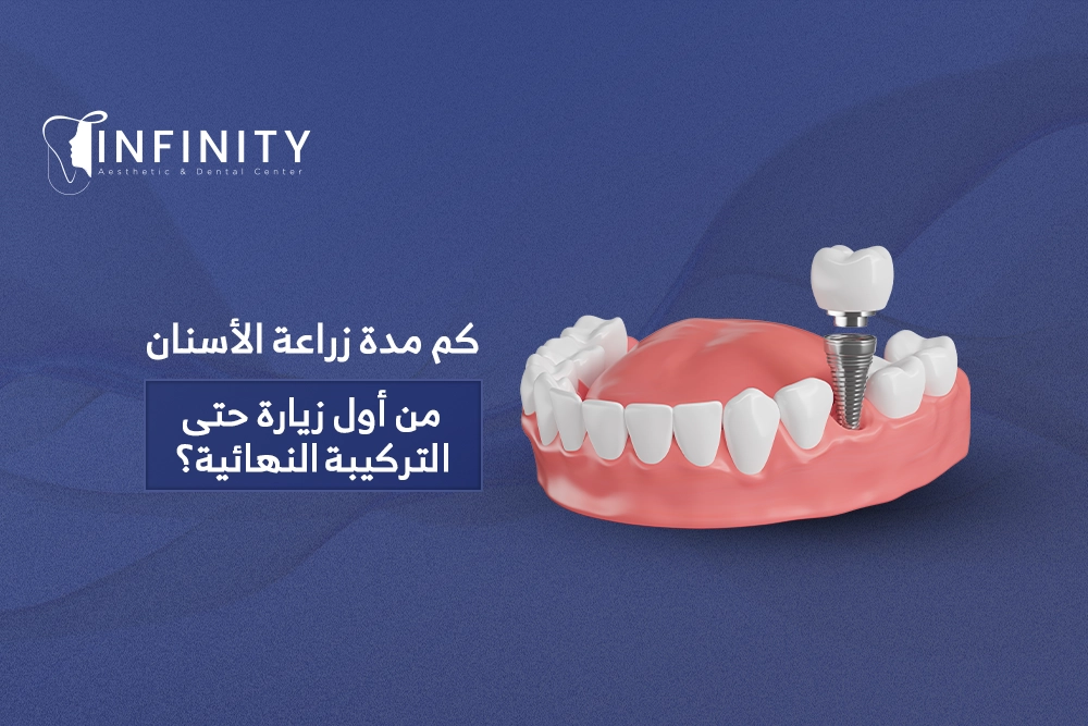 كم مدة زراعة الاسنان