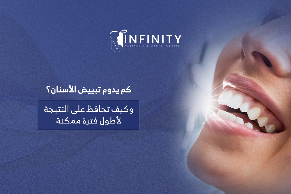 كم يدوم تبييض الاسنان