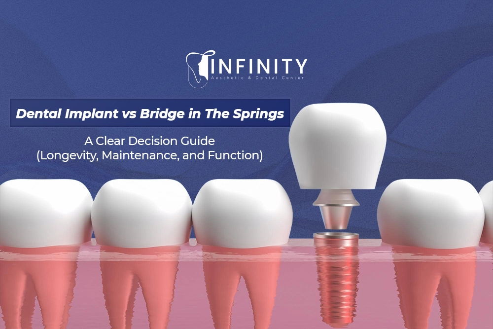 Dental Implant vs Bridge