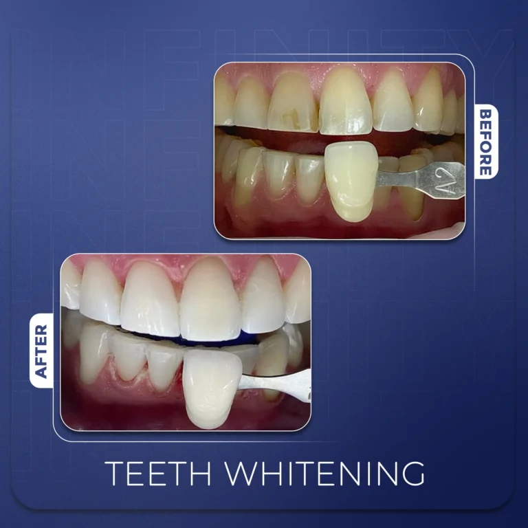 Teeth-Whitening_11zon