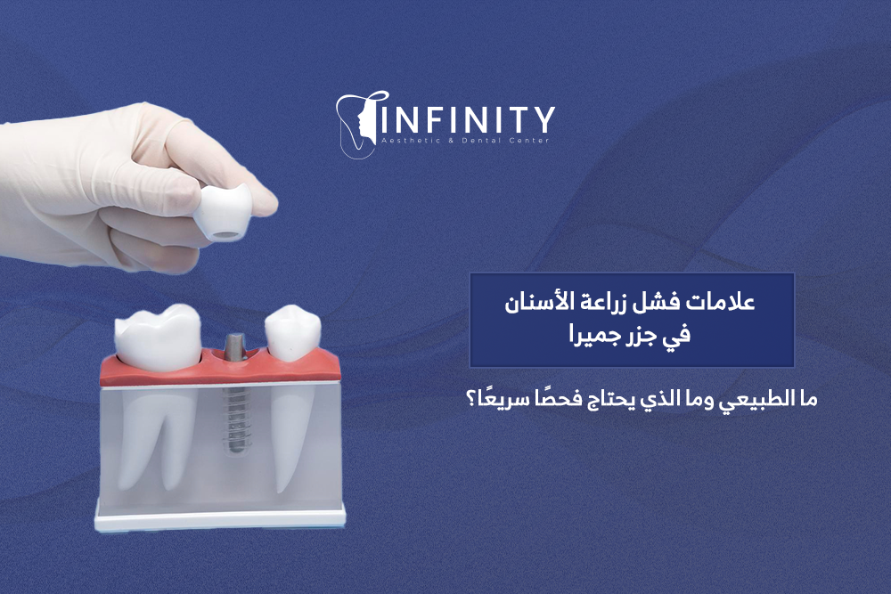 علامات فشل زراعة الأسنان