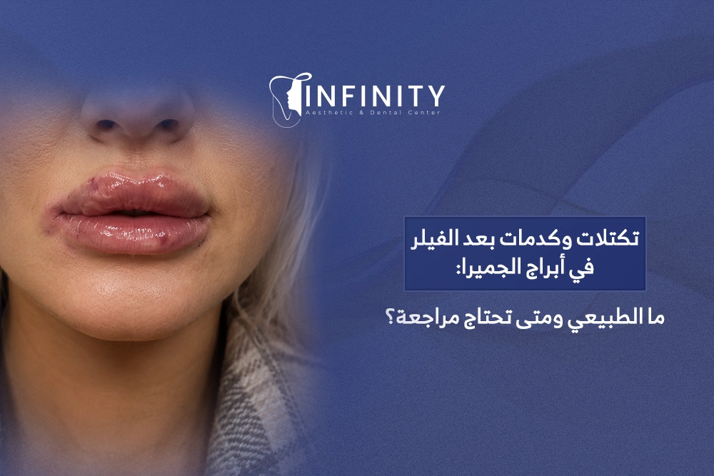 تكتلات وكدمات بعد الفيلر
