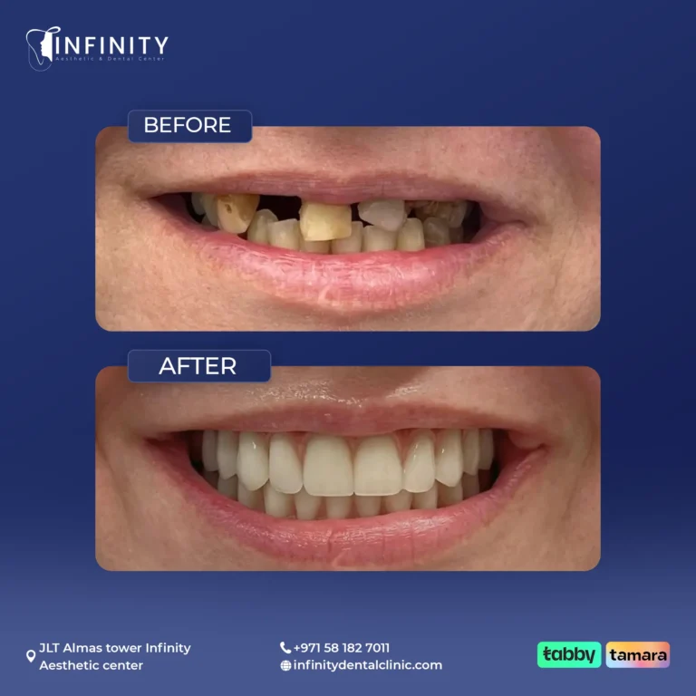 implant case 2