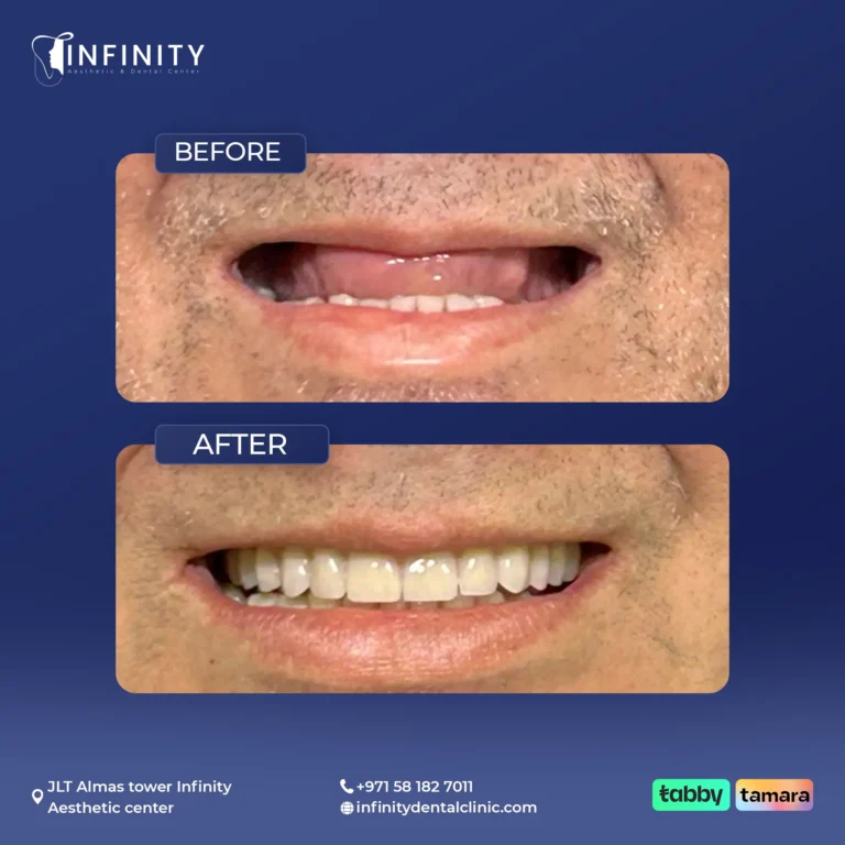 implant case1