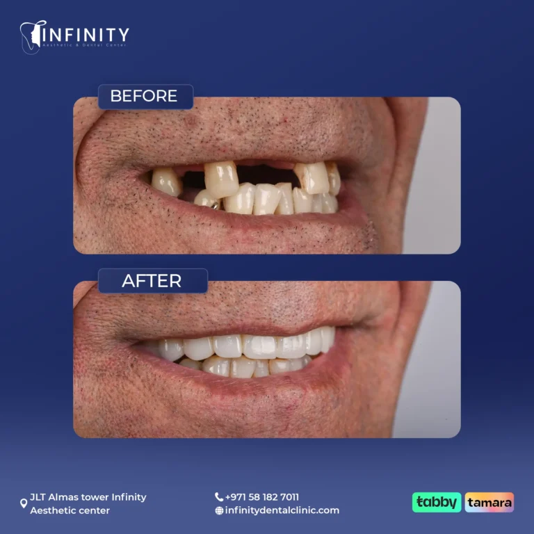 implant case3